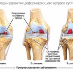 osteoartroz-3