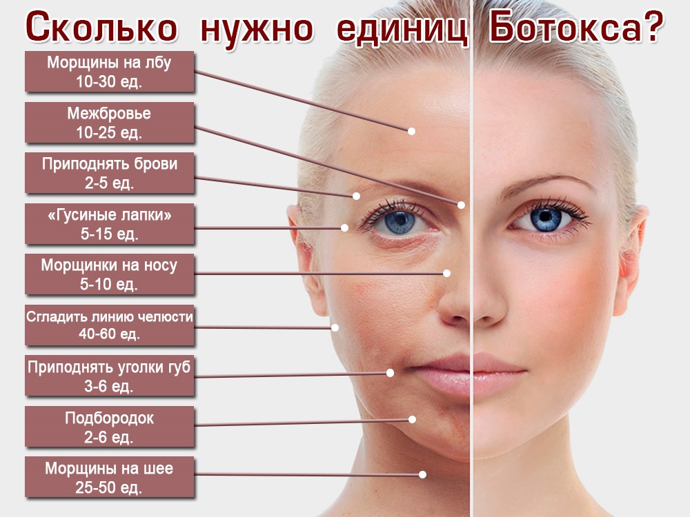 Польза инъекций ботокса для кожи