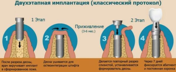 Имплантация зубов в 2026: виды, этапы, цены, риски и как выбрать клинику